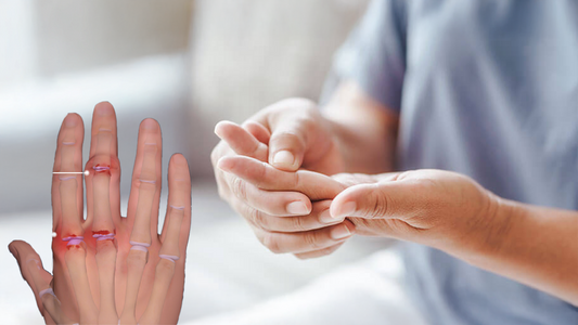 What Are the 4 Stages of Rheumatoid Arthritis?