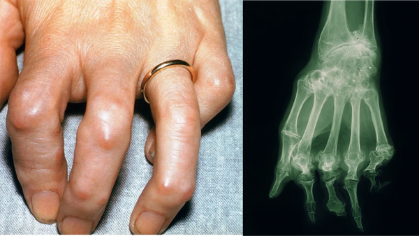 Differential Diagnosis: Reactive Arthritis vs. Rheumatoid Arthritis vs. Gout