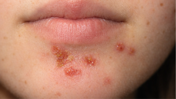 The Link Between Acne and Diet: How High Glycemic Load Impacts Skin Health