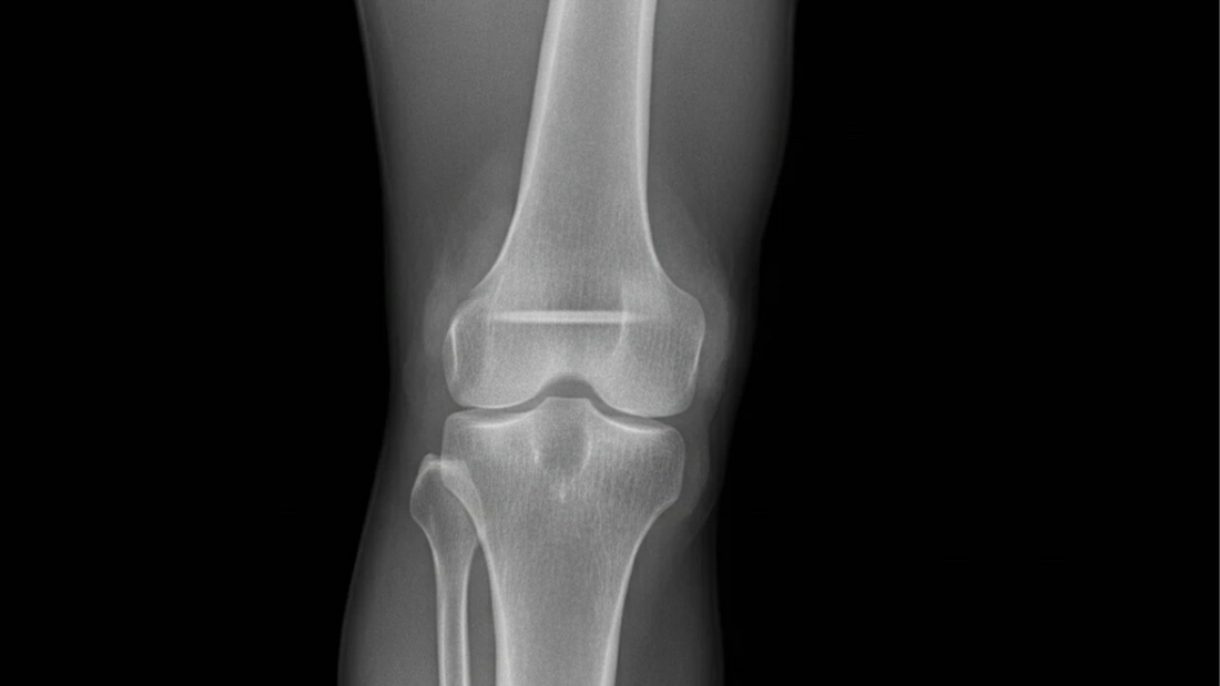 What Causes Joint Effusion and How to Prevent It Naturally